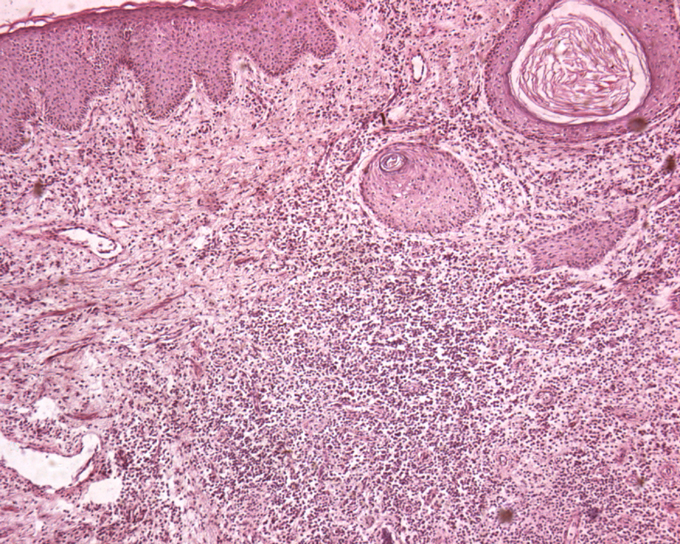 Flogosi Cronica Granulomatosa Gigantocellulare Del Derma